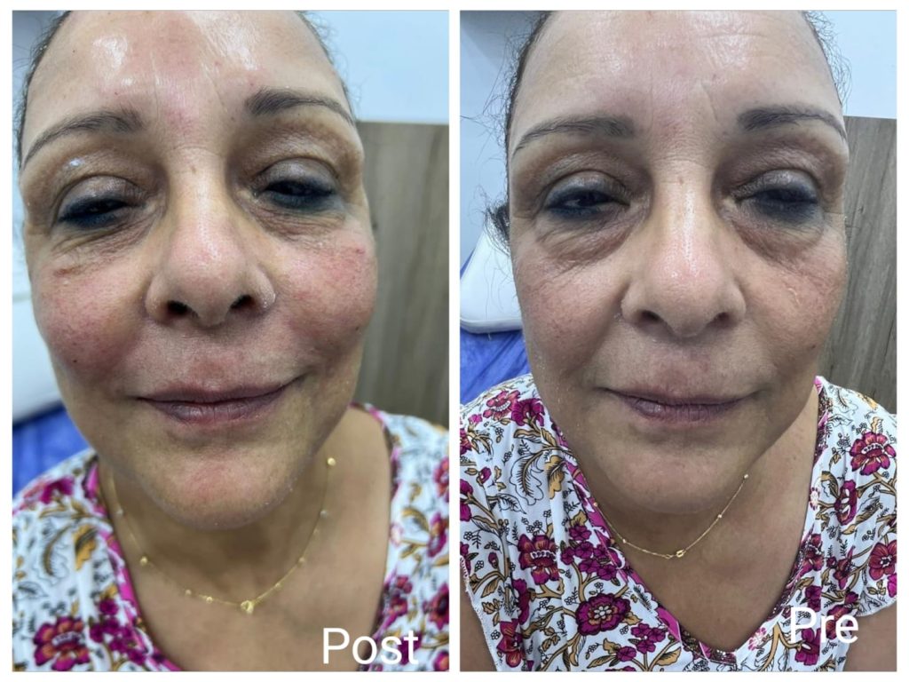 Hyaluronic filler for the face and under the eye